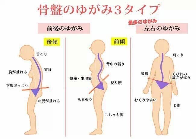 骨盤の歪み３タイプ